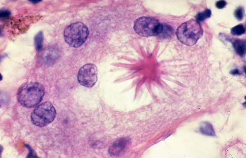 Sarcoidosis Asteroid body by Yale Rosen